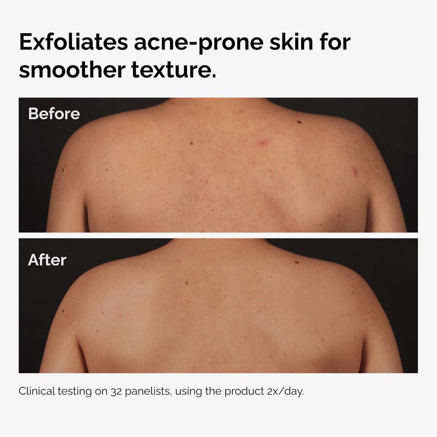 Salicylic Acid 0.5% Body Serum M5 image 2
